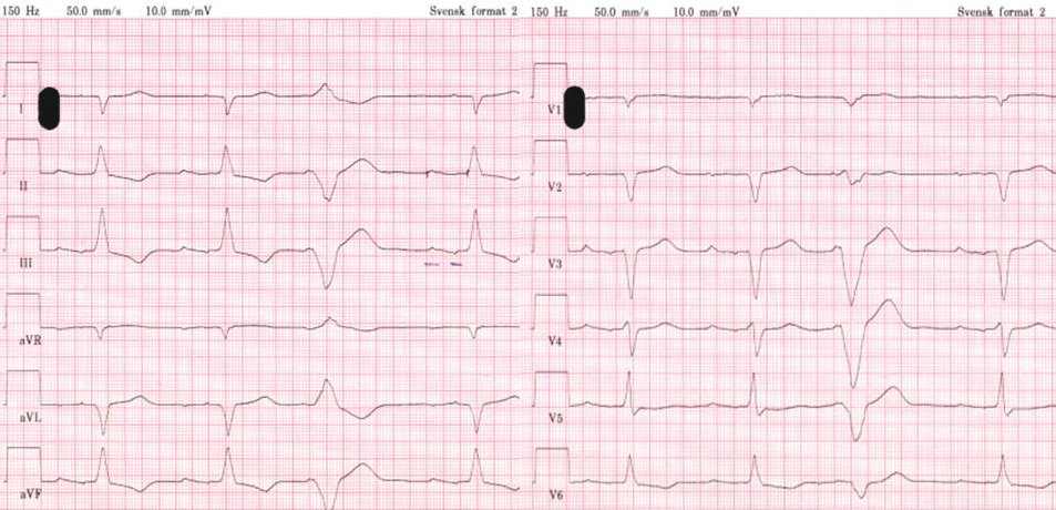 EKG_CHF